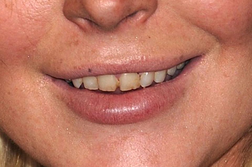 Vor der dentalen Generalüberholung sahen Lindsay Lohans Zähne zum Abgewöhnen aus.