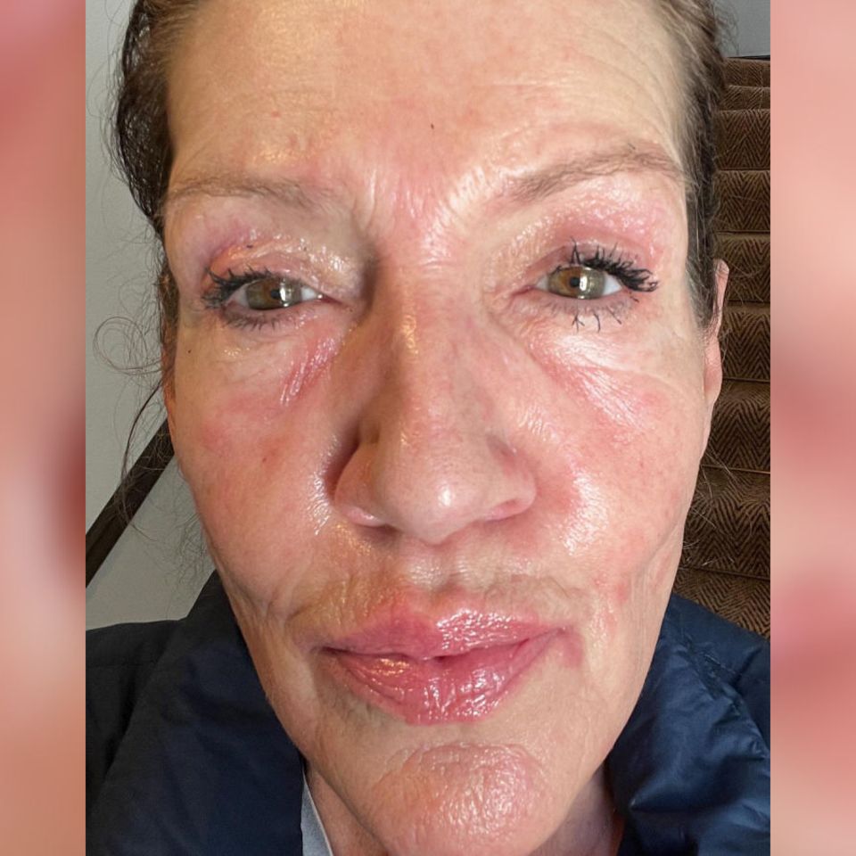 „Die Stellen brannten wirklich sehr“: Allergische Reaktion! Katy Karrenbauer warnt ihre Fans vor Make-up
