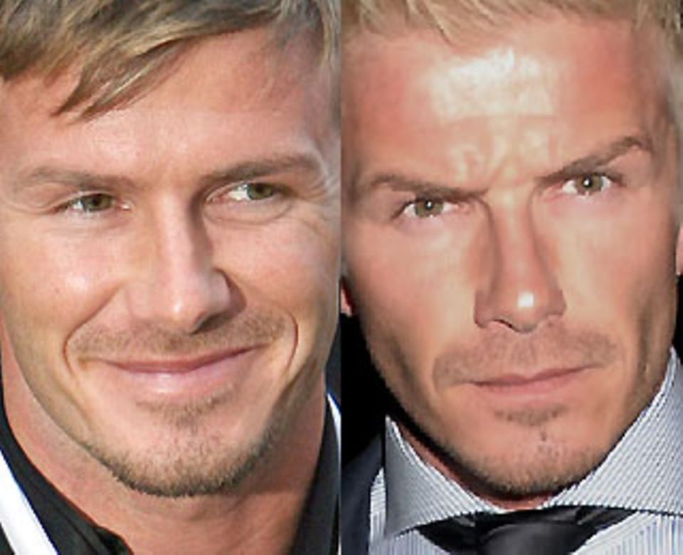 Prominente Botox-Opfer